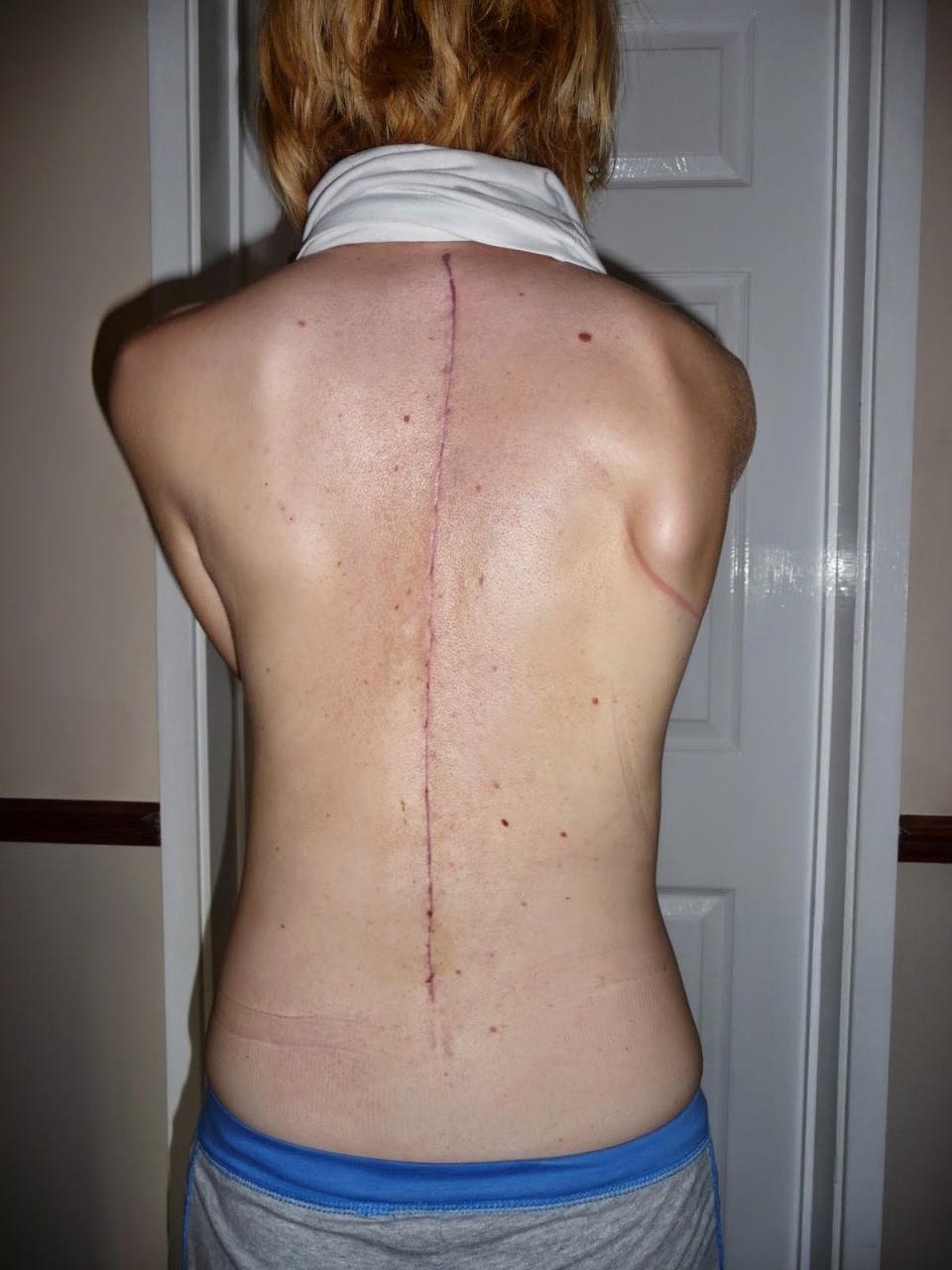 الجنف Scoliosis