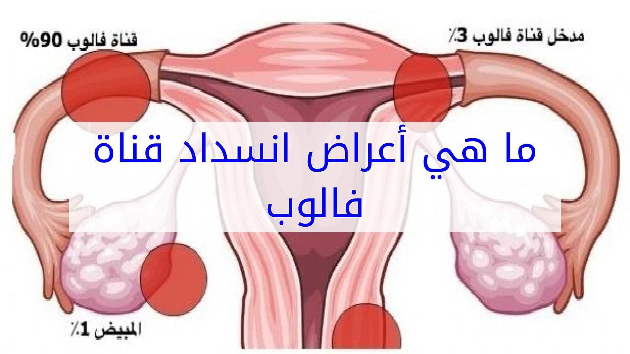 الاسباب الرئيسية لتعرض قناتي فالوب للانسداد - اعراض انسداد قناة فالوب 2103 1