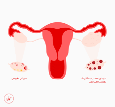 اسئلة واجوبة حول تكيسات المبايض والكلوميد وتاخر الحمل والدورة الشهرية الخ