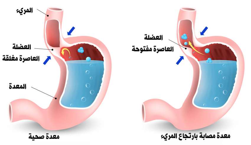 الحبه السوداء لعلاج ارتجاع المرئ 1261