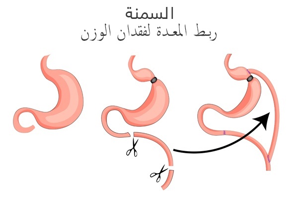 كم سعر ربط المعده الي هي الحلقه - كل ما تودين معرفتة عن ربط المعدة وتكلفتها 3335