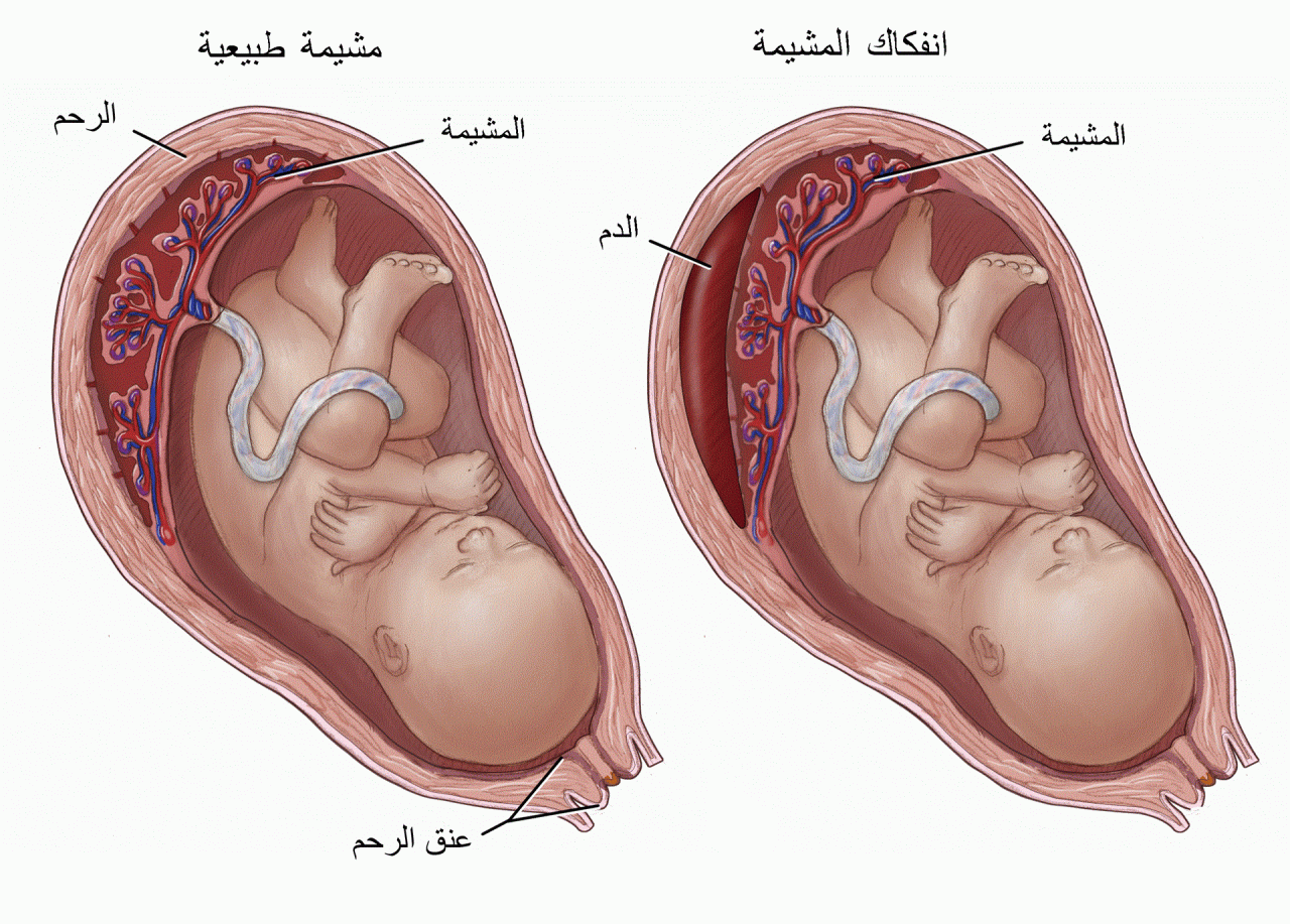 نزول الدم في التاسع بدون طلق - هل من الطبيعي أن ينزل الدم في الشهر التاسع من الحمل- 746