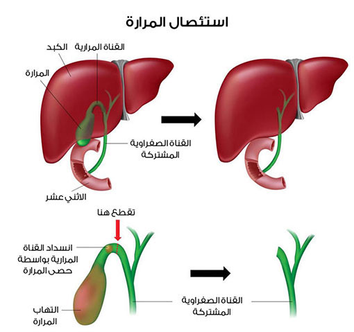 بنات اللي عملية استئصال حصوات المرارة تدخل الله يخليكم