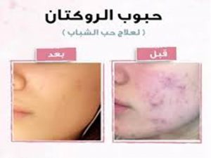 مرجع شامل لكل من استخدمت وتستخدم حبوب Roaccutane لحب الشباب 2