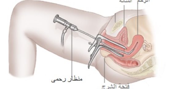 البنات المقبلات علي عملية المنظار الرحمي معلومات وتجارب 3030